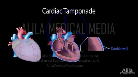 Alila Medical Media | Cardiac tamponade NARRATED animation | Medical ...