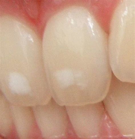 White Spots On Teeth Causes, Treatment, And Prevention, 53% OFF