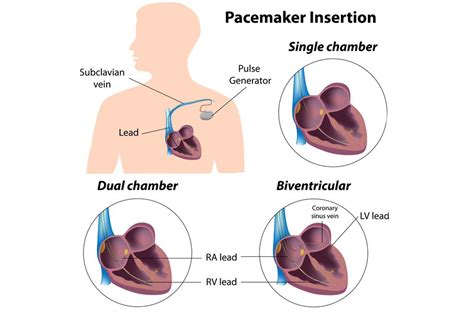 The Health Hub: Pacemaker implantation - Why It Is Performed