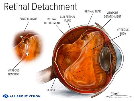 Retinal Detachment: Symptoms Causes, 40% OFF