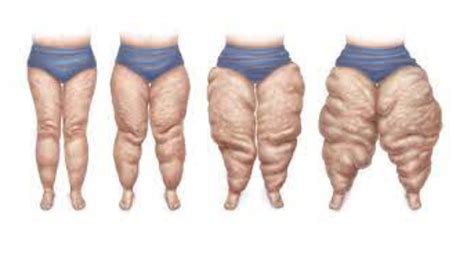 Lipo-Lymphedema Stages, Treatments & Therapy Explained