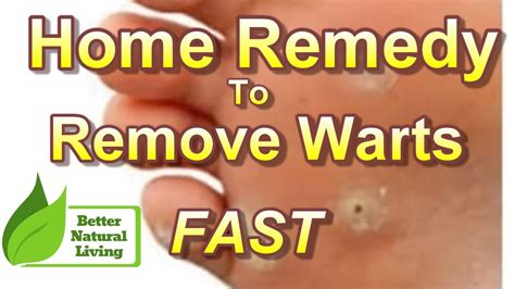 Wart Removal Home Remedies Fast - YouTube