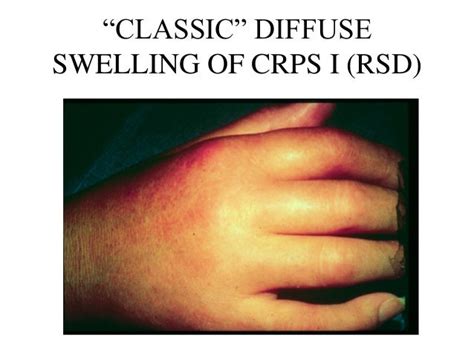 CRPS I (RSD) with pictures. Differential Diagnosis