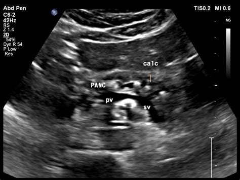 Pancreatic Duct Ultrasound