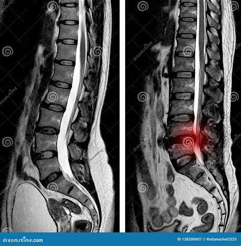 Lumbar Spine Sagittal