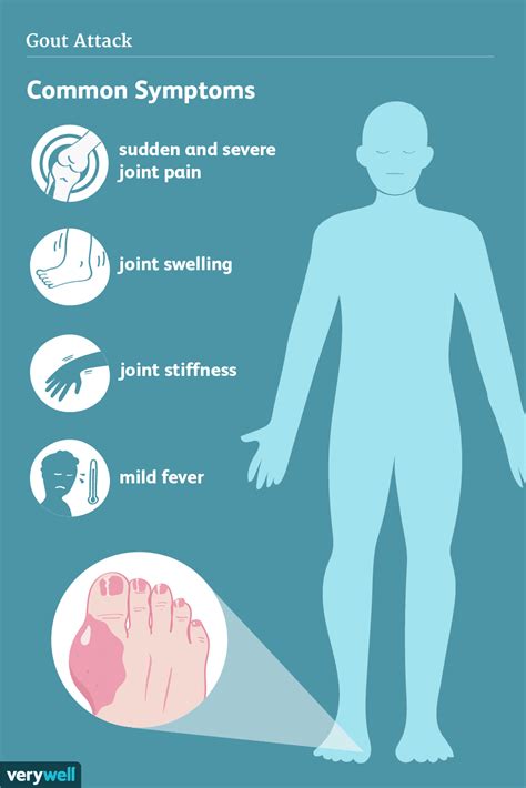 How Gout Is Treated