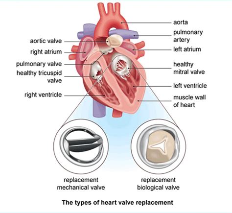 Heart Surgery Types - Open, Bypass, Ablation, Heart Valve surgery