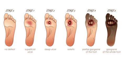 Diabetic Foot Ulcers- Symptoms, Causes, And Risk Factors - Pristyn Care