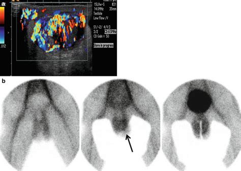 Scrotal Imaging | Radiology Key