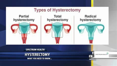 Hysterectomy: What you need to know