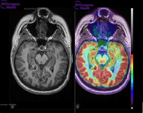 Hashimoto encephalopathy. Positron emission tomographic imaging (right ...