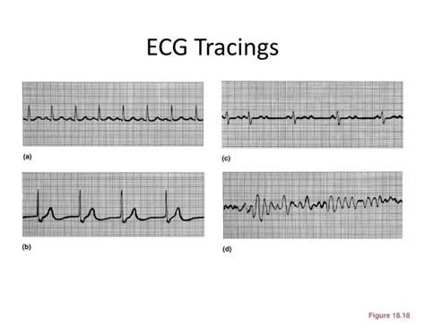 ecg tracings — Printable Worksheet