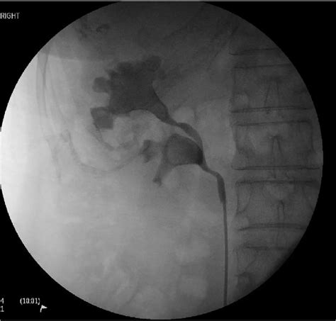 Right retrograde pyelogram as part of pre-operative workup and ...