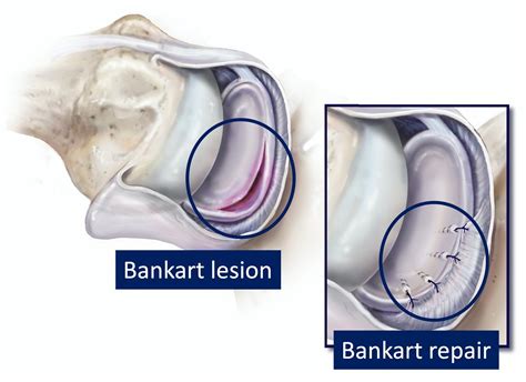 Bankart repairs: How to help athletes return to sport - PhysioX Pte Ltd