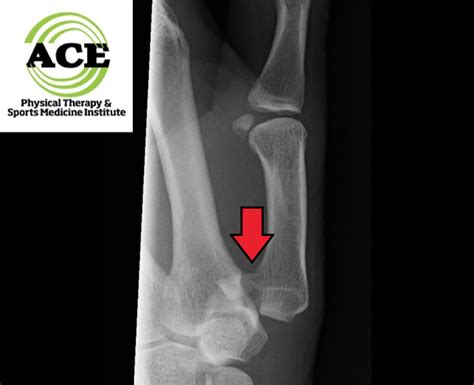 Bennett Fracture Alexandria | Thumb Rehabilitation Arlington