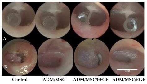 Tympanic Membrane Perforation