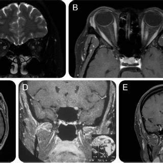 MRI in optic perineuritis | Download Scientific Diagram