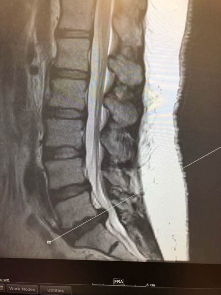 Lumbar Disc Herniation - Stechison Neurosurgery Atlanta, LLC