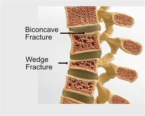 Compression Fracture Diagram