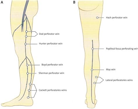 The place of subfascial endoscopic perforator vein surgery (SEPS) in ...