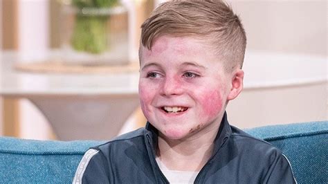 The brave boy living with rare skin disease epidermolysis bullosa ...