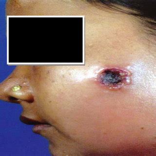 Cutaneous anthrax lesion with black eschar on back of the trunk ...