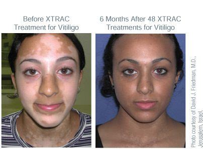 What is Vitiligo? | Definition | Treatment Options