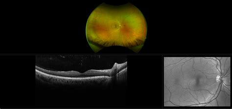 Vitreous Floaters - Case Study