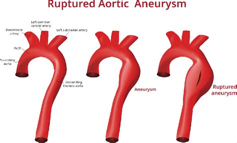 Abdominal Aortic Aneurysm Types