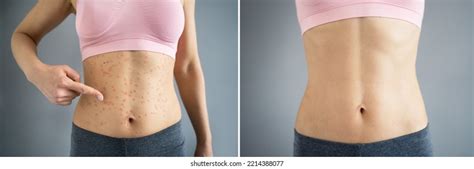 156 Eczema Before And After Images, Stock Photos & Vectors | Shutterstock