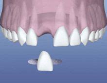 Dental Flipper alternatives: Dental Flipper choices | Dental bridge ...