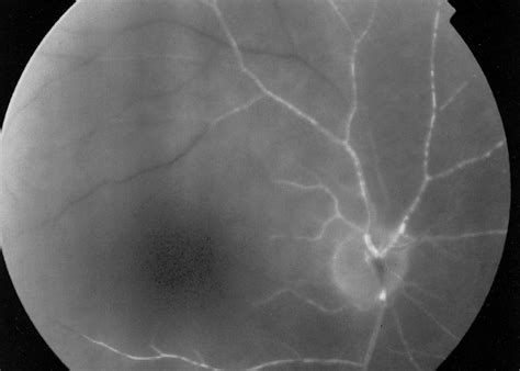 Fluorescein angiography of the right eye at 3 minutes. Note the ...