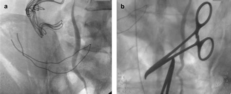 a, 4b. Retrograde pyelogram done intraoperatively, showing a continuous ...