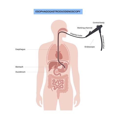 Premium Vector | Gastroscopy procedure Gastroenterologist uses a ...