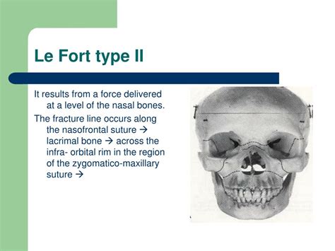 PPT - MIDFACE FRACTURES PowerPoint Presentation, free download - ID:5119750