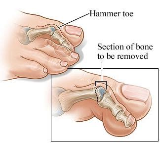 Hammertoe Surgery NYC | Hammertoe Treatment Specialist Manhattan