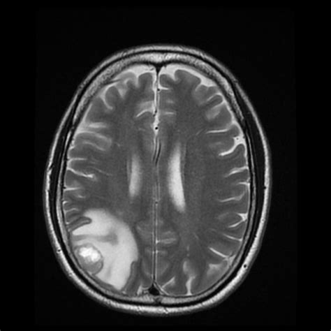 Brain Tumor… | EM REMS