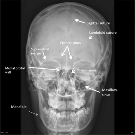 Superior Orbital Fissure Radiology