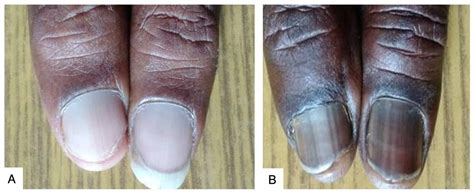 Figure 1 from Prevalence of nail changes in patients infected with HIV ...