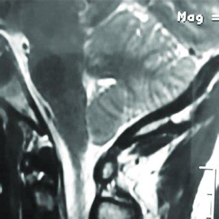 After performing a valveless lumboperitoneal shunt, the cerebral MRI in ...