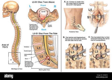 L5-S1 Lumbar Disc Herniation with Surgical Discectomy and Stock Photo ...