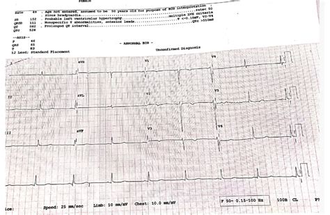 ECG showing prolonged QTc interval | Download Scientific Diagram