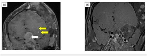 Preoperative post-contrast T1-weighted MRI sella and brain suggestive ...