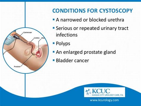 Cystoscopy - Detect and Treat Symptoms of Bladder Cancer