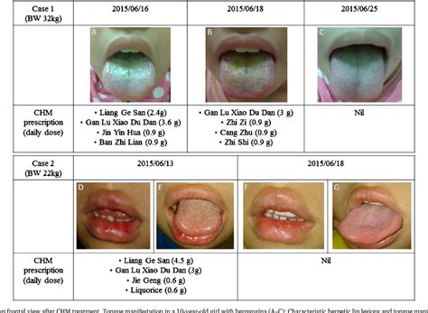 Figure 1 from Management of viral oral ulcers in children using Chinese ...