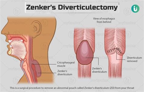 Zenker's Diverticulectomy: Procedure, Purpose, Results, Cost, Price ...