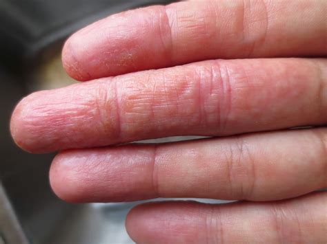 SKIN DISEASE TYPES: Vesicular Hand Dermatitis (Skin Disease type)