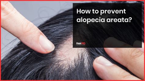 Alopecia Areata: Food Diet, Home Remedies And Treatments