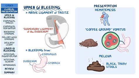 Gastrointestinal bleeding: Pathology review: Video | Osmosis