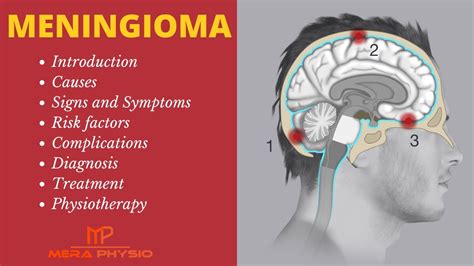 Meningioma | Intro, Causes, Symptoms, Complications, Diagnosis ...